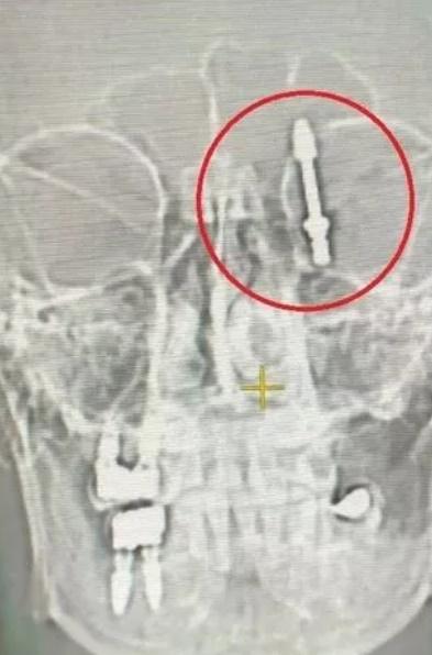 X 光顯示事主腦中的植牙螺絲。(網上圖片)