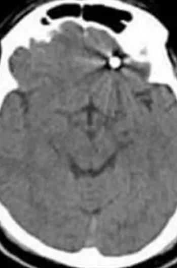 X 光顯示事主腦中的植牙螺絲。(網上圖片)