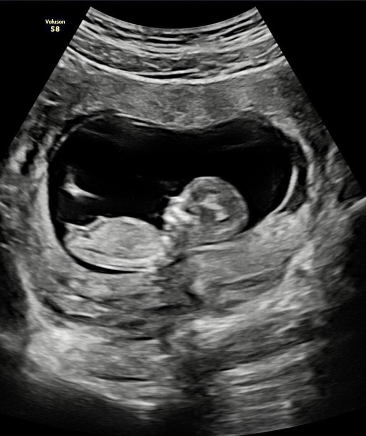 賴弘國昨日上載超聲波照,宣布今年會再老竇。