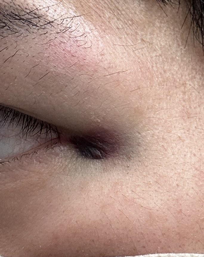 受害人Reimon的傷勢。(X)