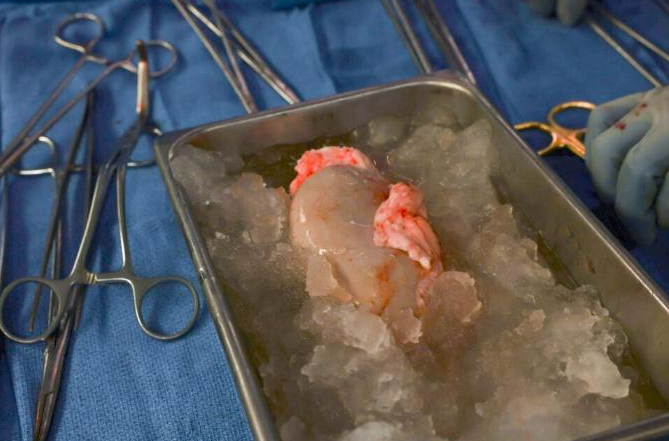 斯來曼在麻省總醫院接受了全球首宗基因豬腎移植手術。(資料圖片)