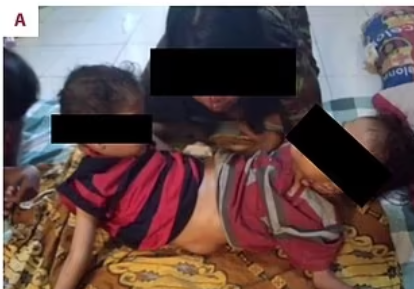 由於二人腹部以下相連,出世後一直被迫平躺,無法坐起來,直到3歲時進行複雜手術,截去第三條腿,才可以坐直,並穩定了兩兄弟的臀部及盆骨,才使他們能夠正常坐起來