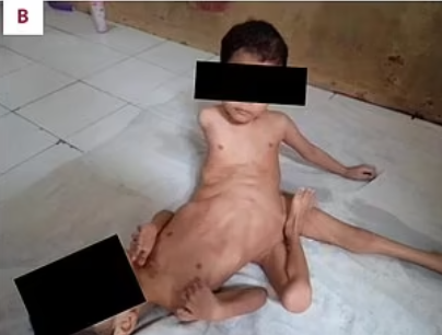 由於二人腹部以下相連,出世後一直被迫平躺,無法坐起來,直到3歲時進行複雜手術,截去第三條腿,才可以坐直,並穩定了兩兄弟的臀部及盆骨,才使他們能夠正常坐起來