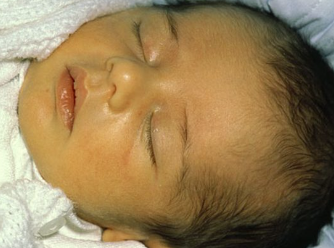 患新生兒黃疸的寶竇,皮膚及眼白會呈現黃色。(互聯網)