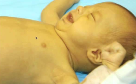 患新生兒黃疸的寶竇,皮膚及眼白會呈現黃色。(互聯網)