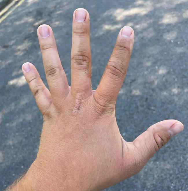 他指,隔天醒來,自己的臉部出現三級燒傷,手部也因燒傷慘變色。(dailymotion)