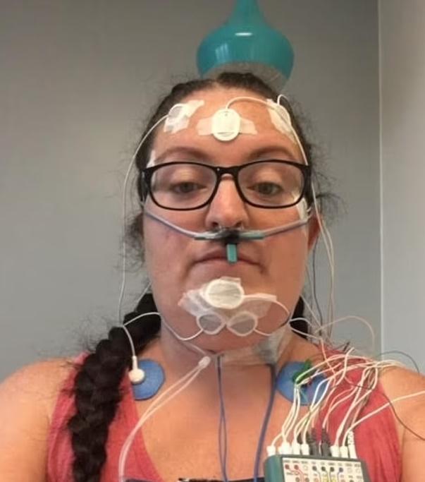 雖然她使用呼吸器能改善呼吸,減少夢遊,但呼吸器會壓迫下巴,導致她在睡覺時摘除。(X)