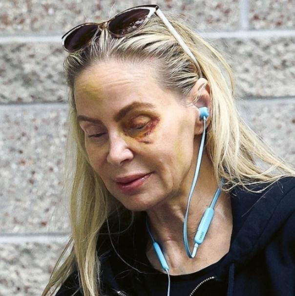 日前有傳媒拍攝到Christina,她面部及左眼有明顯瘀傷。(網上圖片)