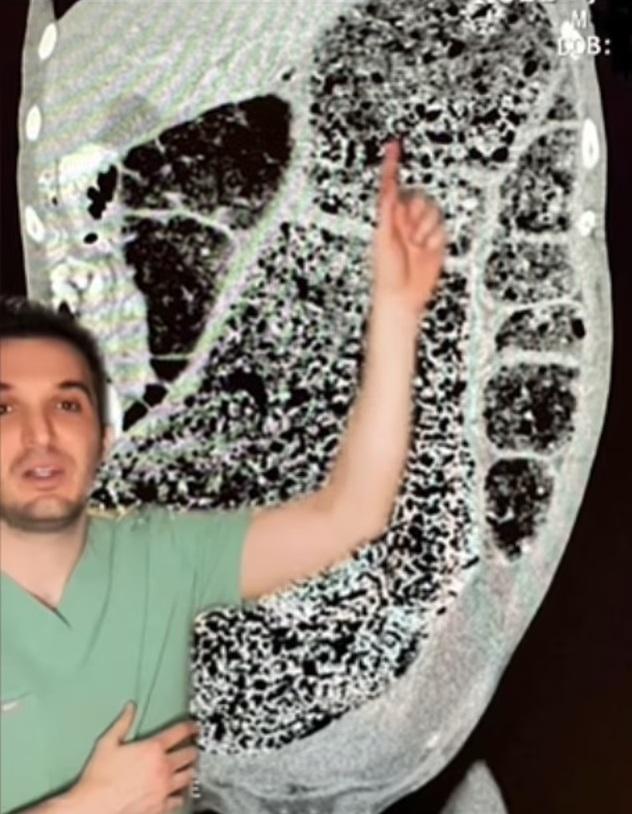 醫生沙法在TikTok講解男子3個月沒排便的病例。(互聯網)