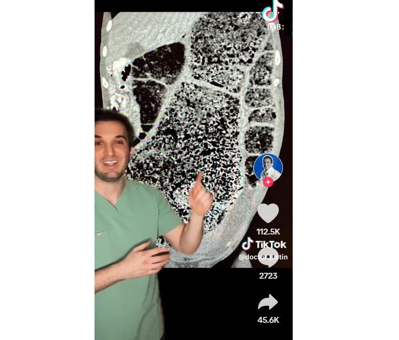 醫生沙法在TikTok講解男子3個月沒排便的病例。(互聯網)