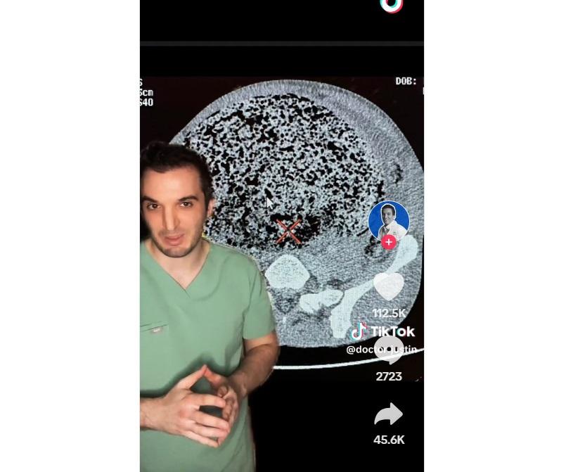 醫生沙法在TikTok講解男子3個月沒排便的病例。(互聯網)