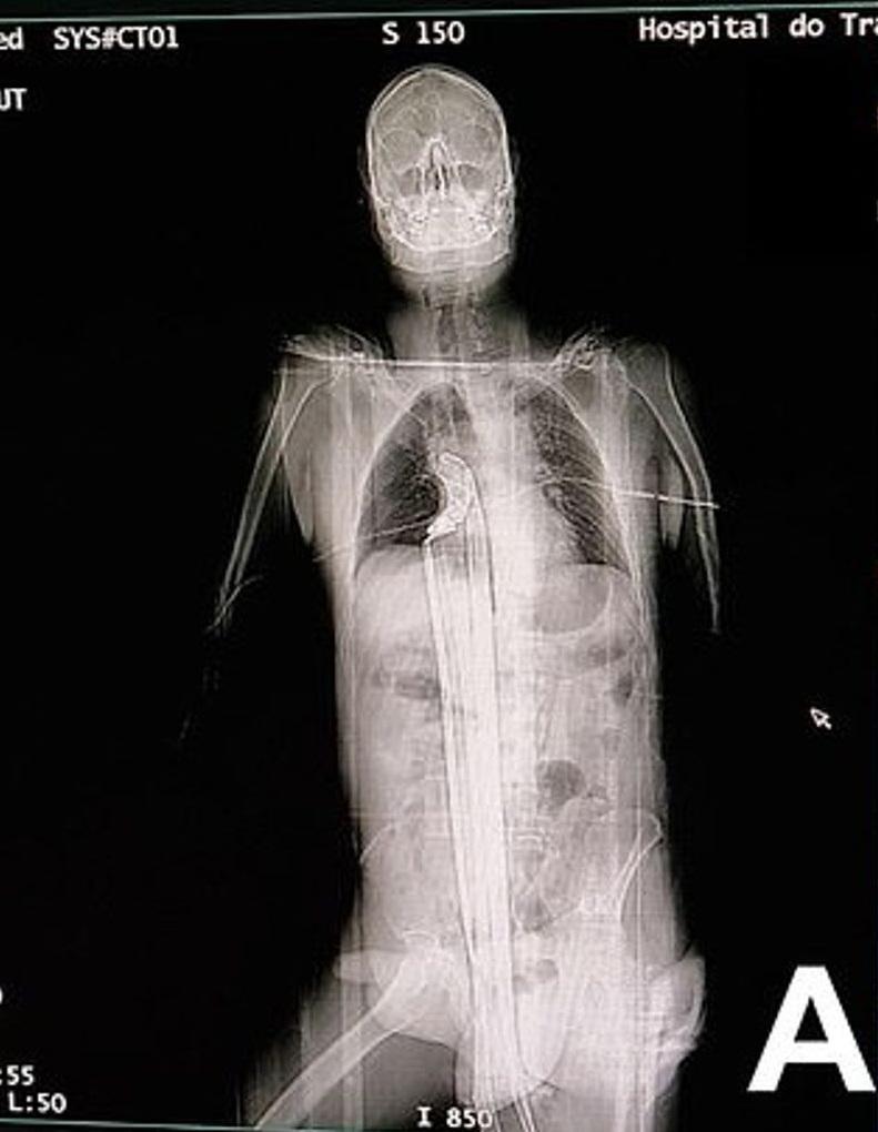 掃描圖像顯示,長鋼條從男子下體插進體內,直到肺部下方。(互聯網)