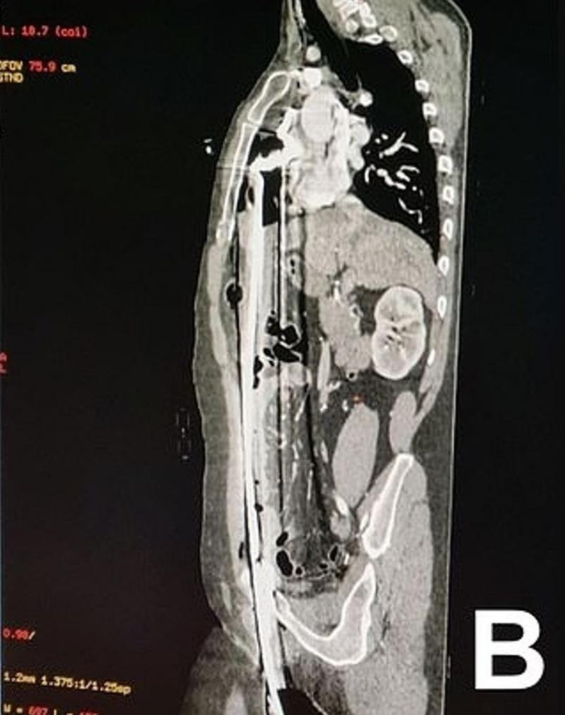 掃描圖像顯示,長鋼條從男子下體插進體內,直到肺部下方,但避過心臟。(互聯網)