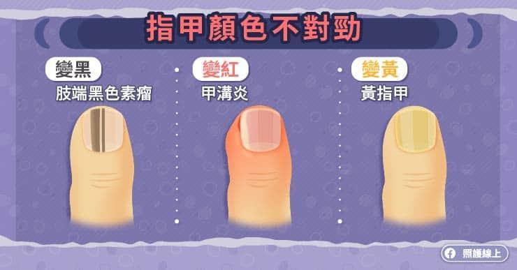 指甲顏色不對勁。(照護線上)