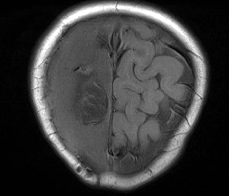 小雪兒目前腦部情況變壞,最新腦素描影像報告,「右邊紋路可能清晰,左邊則呈一片空白」,顯示左腦萎縮(《東張西望》畫面)