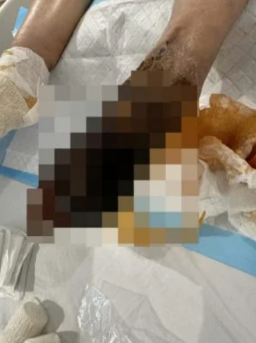 雙手雙腳日漸發黑,只好截肢保命。(互聯網)