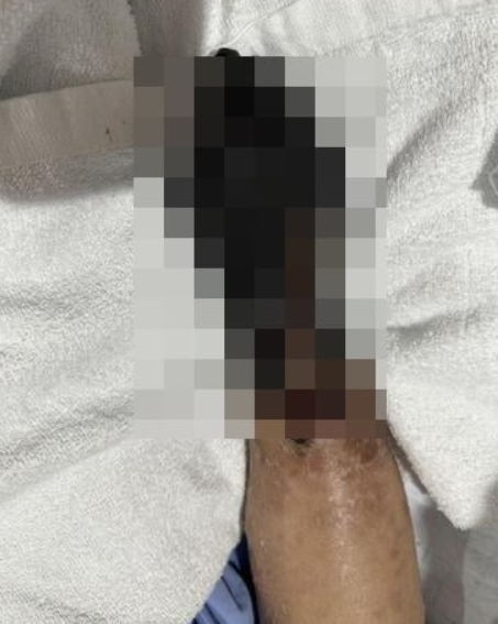 雙手雙腳日漸發黑,只好截肢保命。(互聯網)