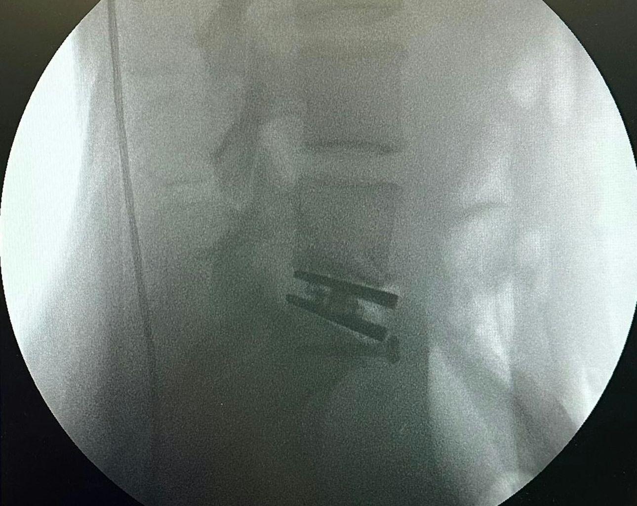 徐濠縈在IG上載了數張X光片。