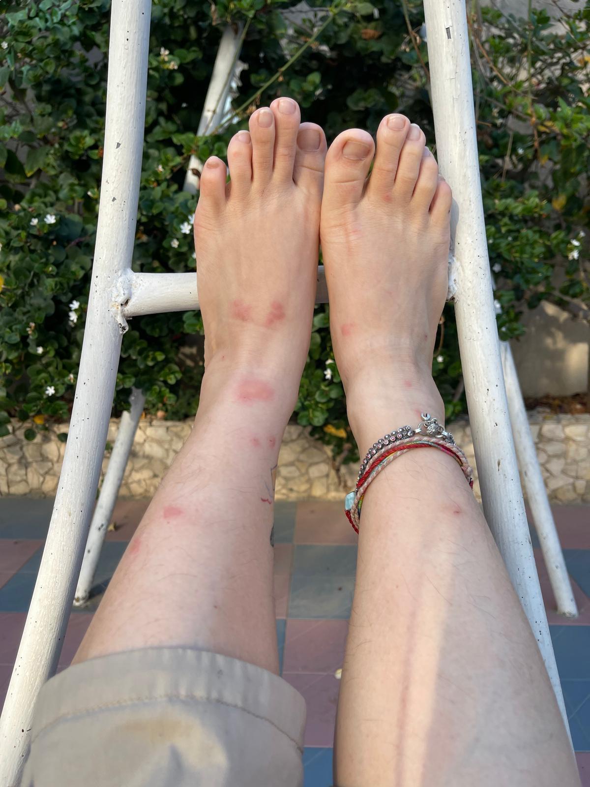 戰事令加沙的衛生條件惡化,皮膚病肆虐,Krystal在當地工作時亦受感染。 (無國界醫生提供)