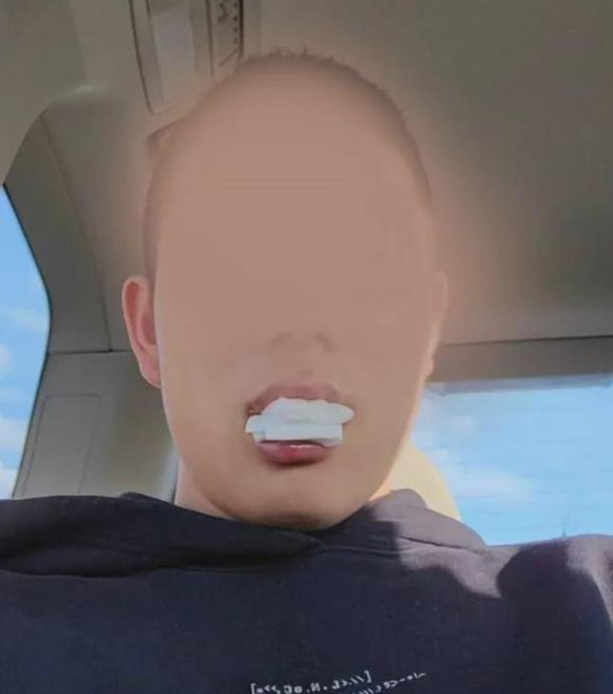 一名16歲中國留學生上周在新西蘭奧克蘭的巴士上,遭人用金屬棍襲擊,面部嚴重損傷。(網上圖片)