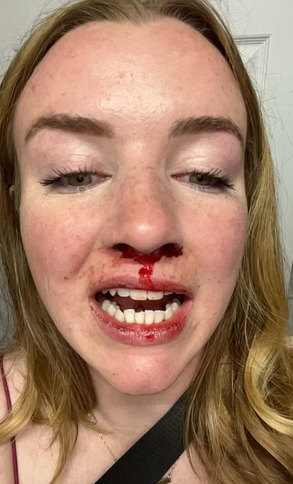 MacLean被打至流鼻血、崩牙及咀唇爆裂。(互聯網)