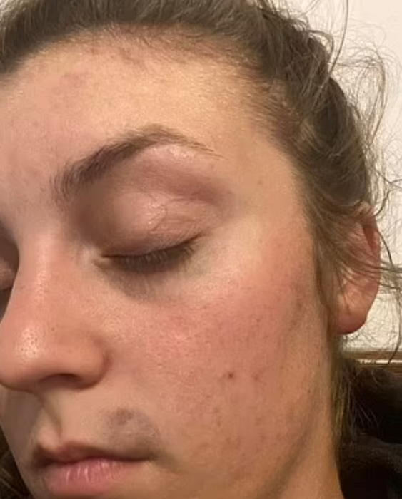 Hogan眼窩、咀部及面部多處瘀傷。(互聯網)