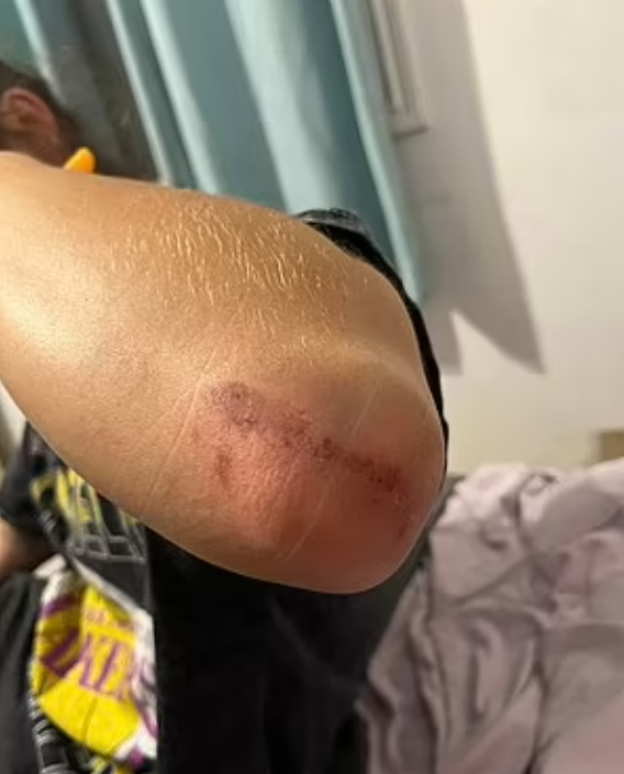 Hogan手肘受傷。(互聯網)