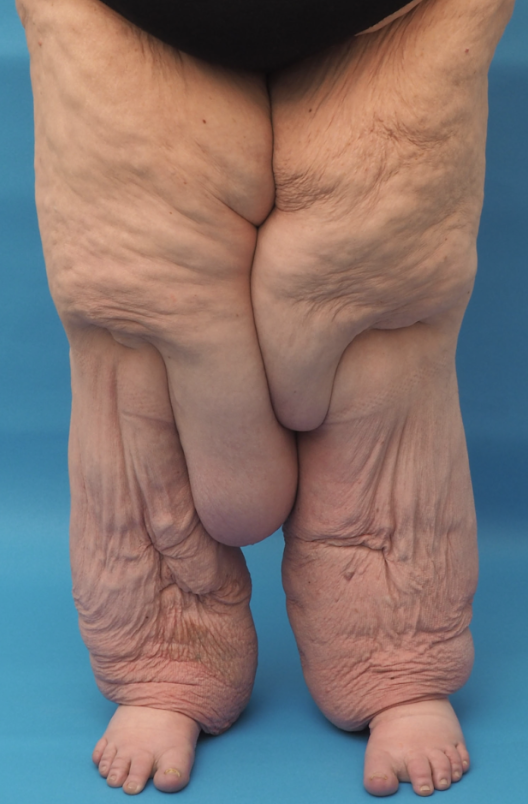 莎拉動手術前的雙腿。(互聯網)