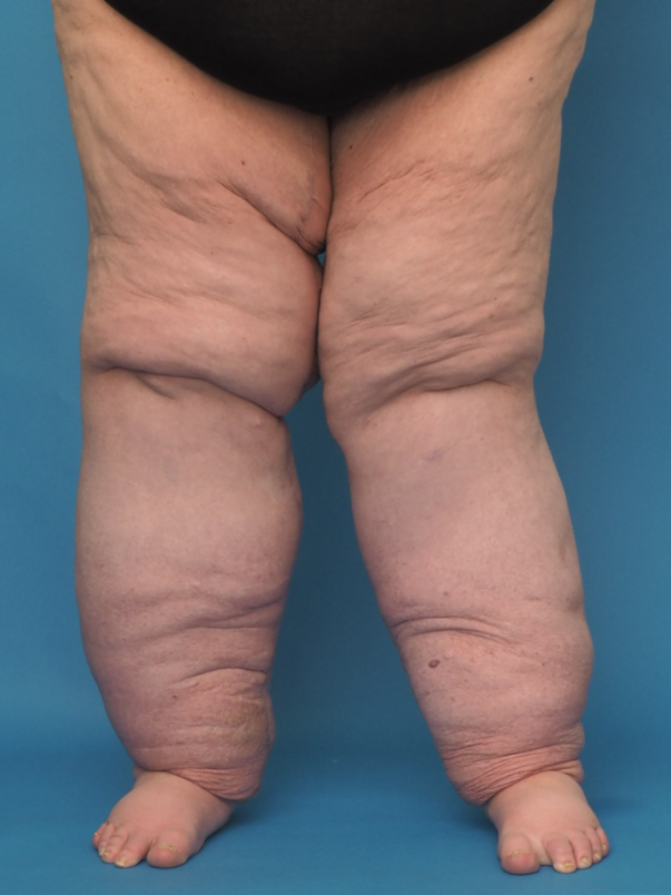 莎拉動手術後的雙腿。(互聯網)