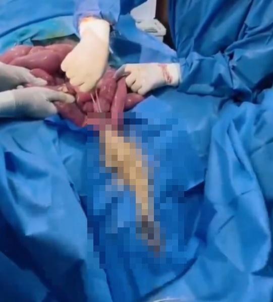 大量活生生的蛔蟲瘋狂蠕動爬竄出來,就如將長意大利粉傾倒下去般,讓人看得渾身發毛。(X)