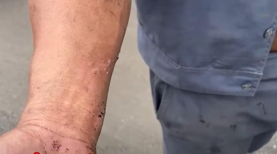 另一名工人亦觸電,手部燒傷。(互聯網)