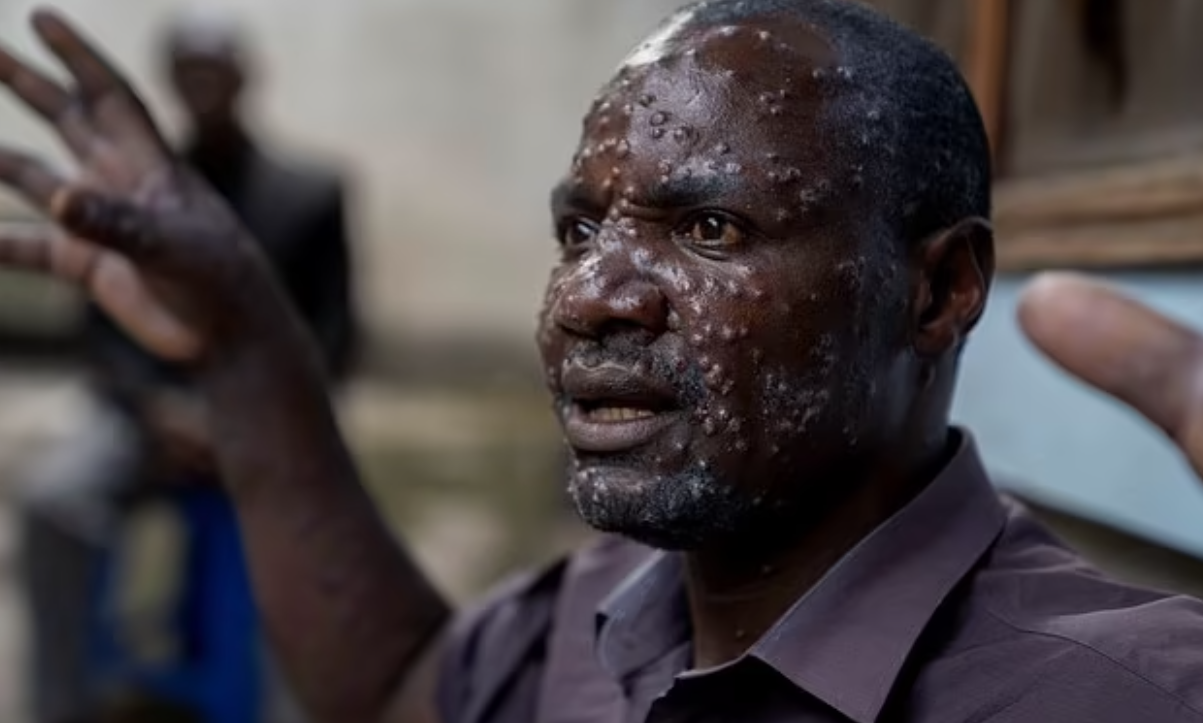 猴痘在非洲爆發,預料會蔓延至包括歐洲等其他地區。(美聯社)