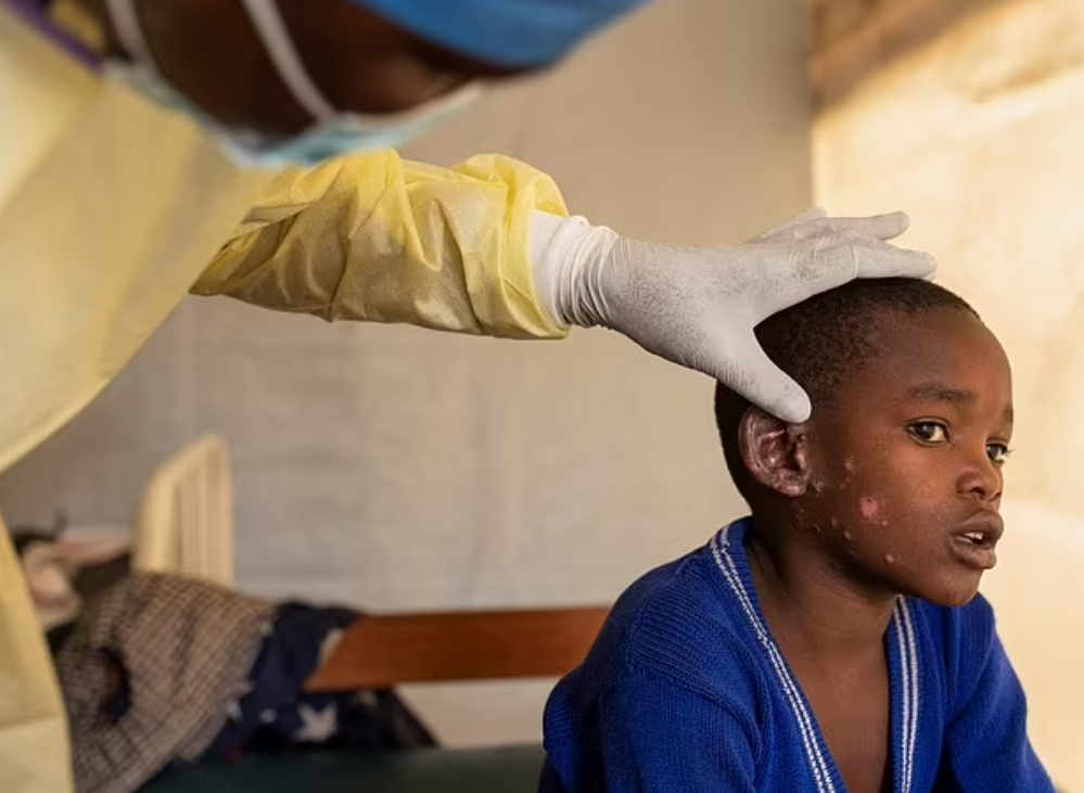 猴痘在非洲爆發,預料會蔓延至包括歐洲等其他地區。(美聯社)