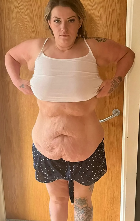 Sara因縮胃手術成功減肥,但腹部皮膚鬆弛。(互聯網)