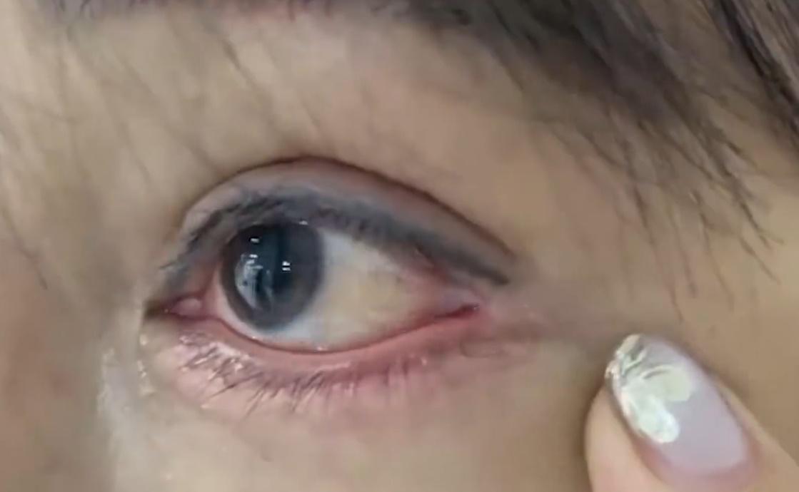 張女因視力模糊,只能依靠眼藥水緩解不適,嚴重影響日常生活,甚至造成她開始出現抑鬱和脫髮等症狀。(微博)