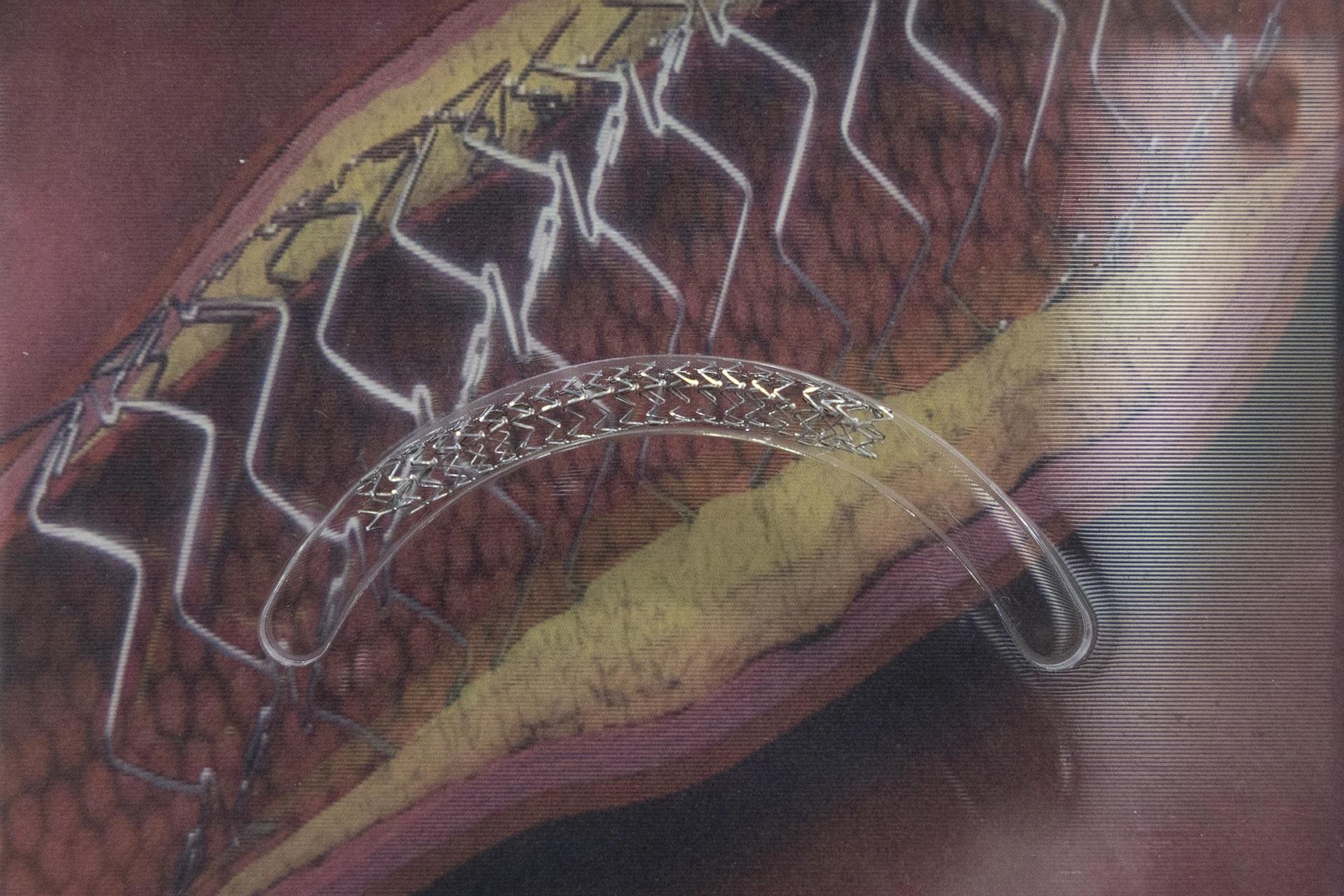 中心今年引入部分可溶性支架,餘下金屬部分支撐血管,於術後保持血管彈性。