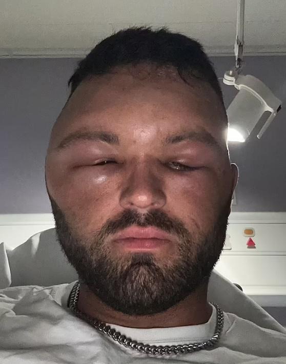 當晚Ryan的腫脹情況持續並蔓延至臉部,可說是面目全非,甚至無法睜開眼睛。(網上圖片)