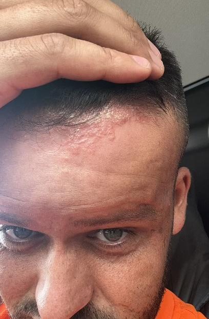 他感到頭皮灼熱,幾個小時後,他的髮線周圍出現皮疹。(網上圖片)