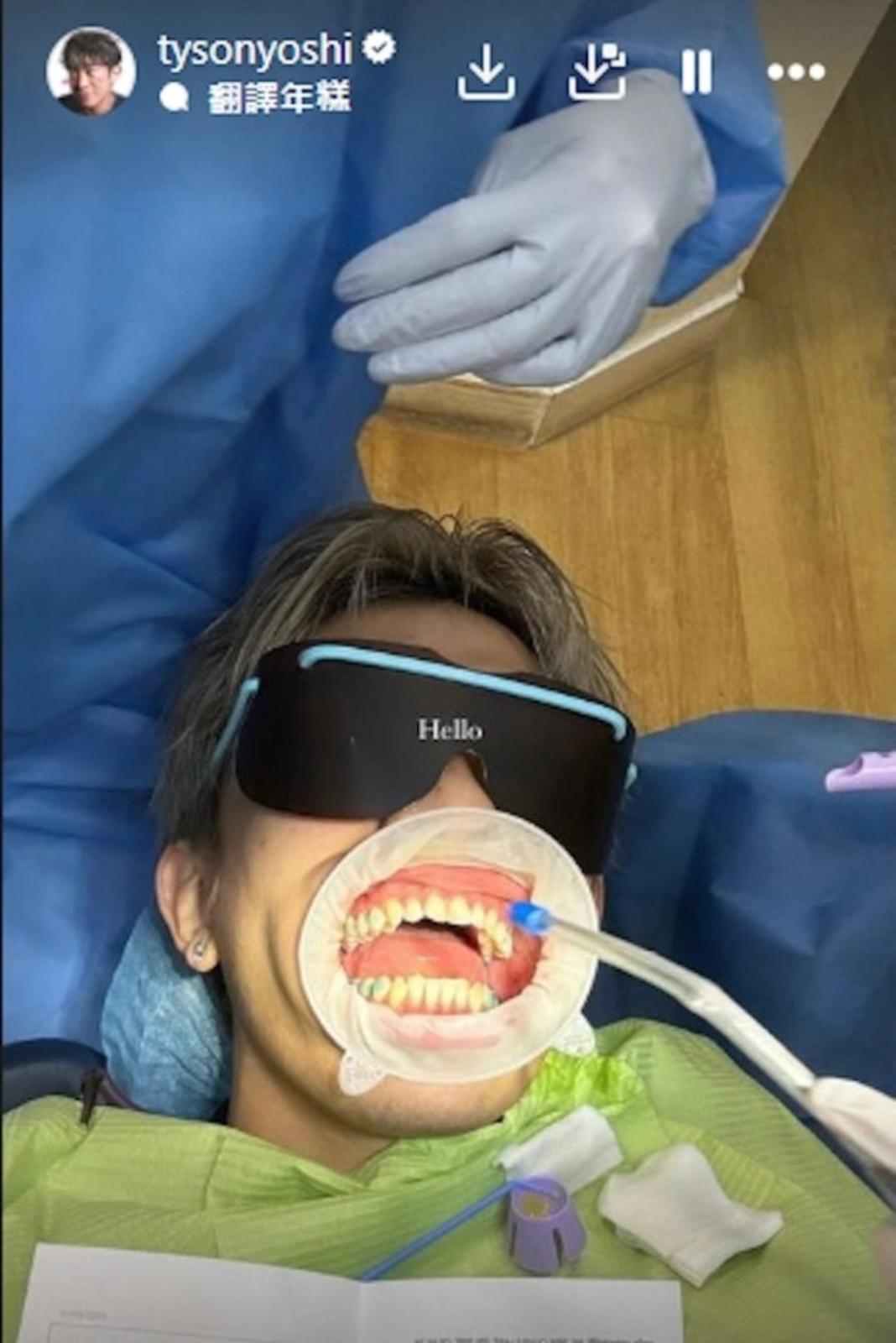 Tyson Yoshi箍牙照片原本是他覺得樣子很搞笑,跟網民分享。