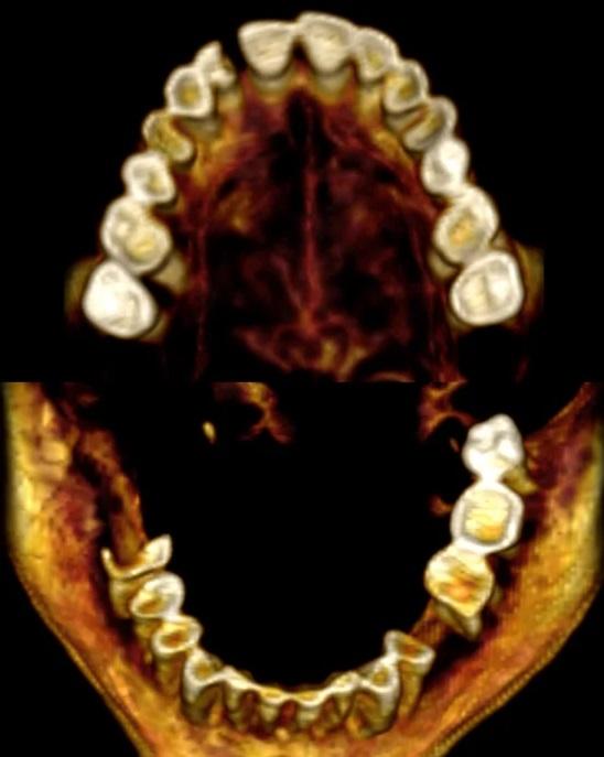 科學家掃描「尖叫女子」的牙齒結構。(互聯網)