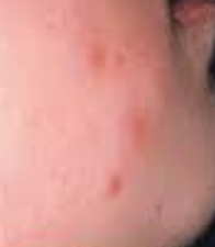 JMML顯著病徵包括原因不明的皮疹。(互聯網)