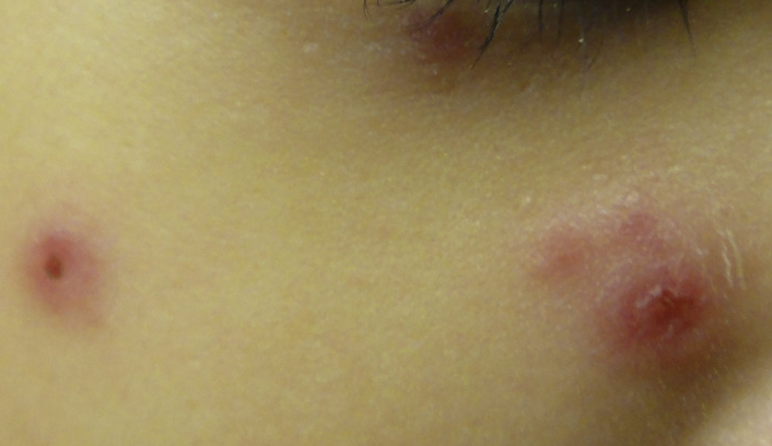 JMML顯著病徵包括原因不明的皮疹。(互聯網)