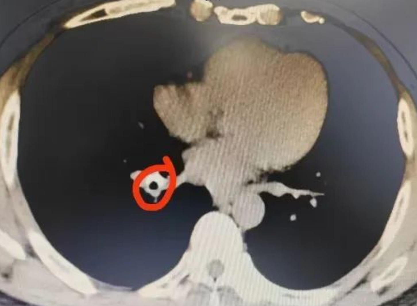 東莞一名男子近年出現反覆胸悶,經檢查發現肺部氣管有異物,取出後竟是半粒花生,原來是他9年前食花生時嗆咳「卡肺」引致。(網上圖片)