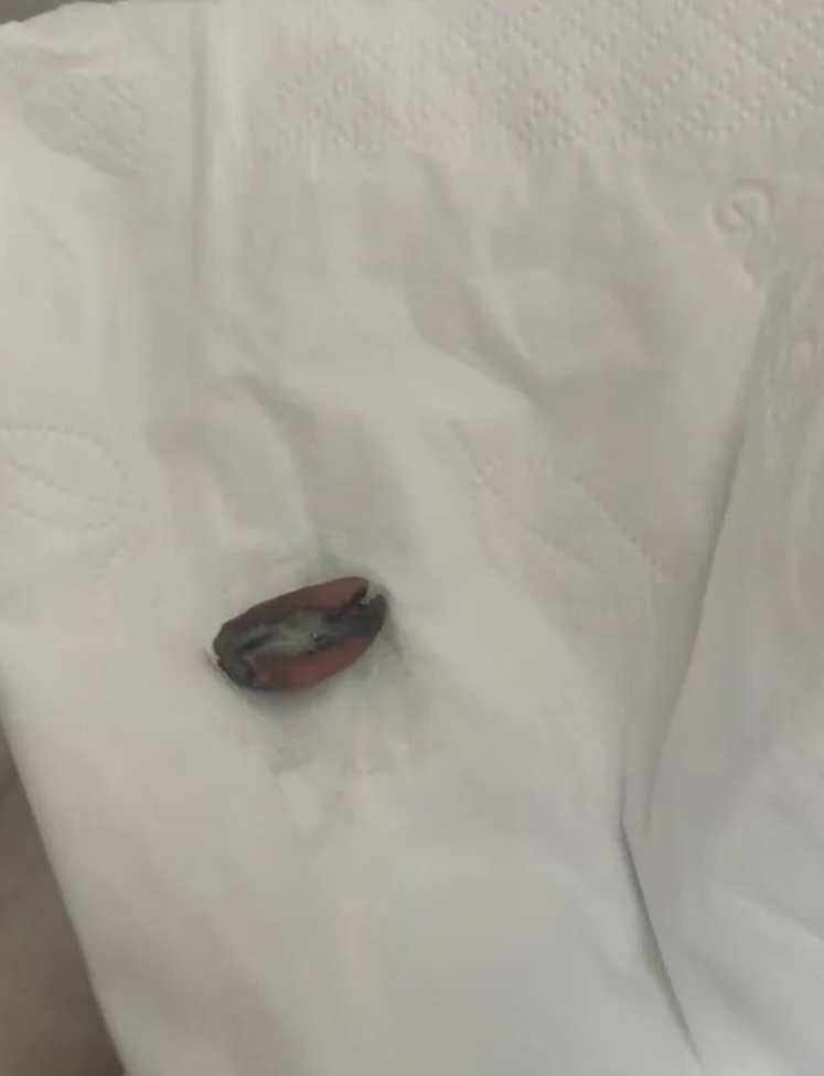 東莞一名男子近年出現反覆胸悶,經檢查發現肺部氣管有異物,取出後竟是半粒花生,原來是他9年前食花生時嗆咳「卡肺」引致。(網上圖片)