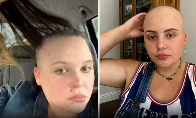 狂掉頭髮時期(左)及剃光頭後。(互聯網)