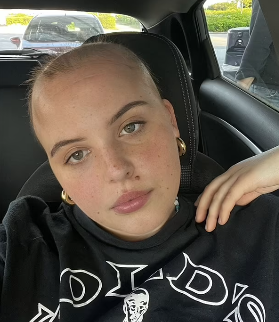 剃光頭後有新頭髮長出。(互聯網)