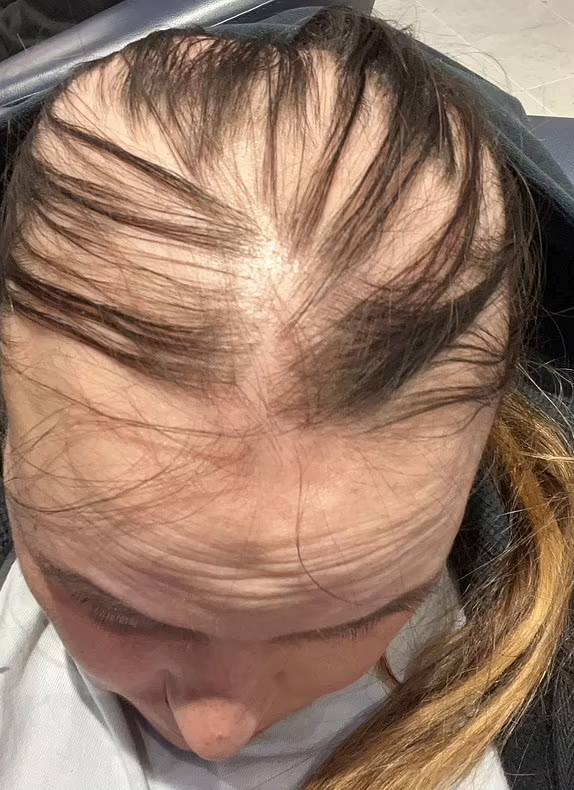 狂掉頭髮時期。(互聯網)