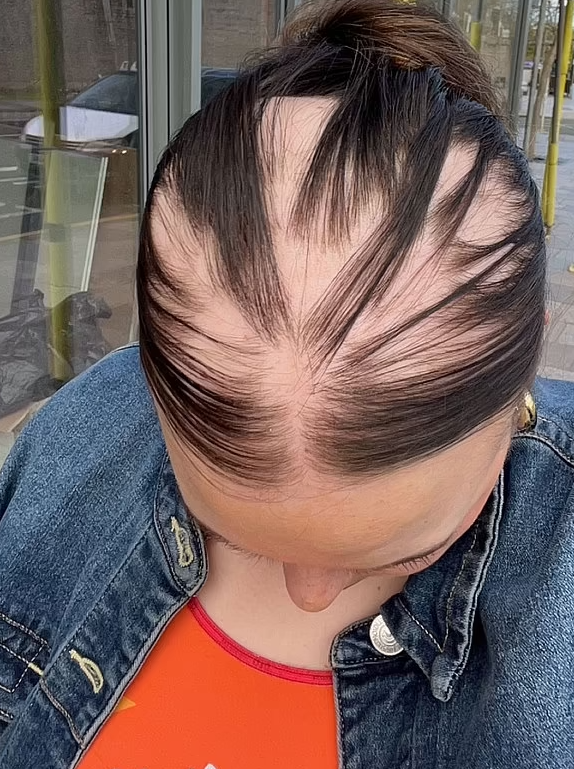 狂掉頭髮時期。(互聯網)