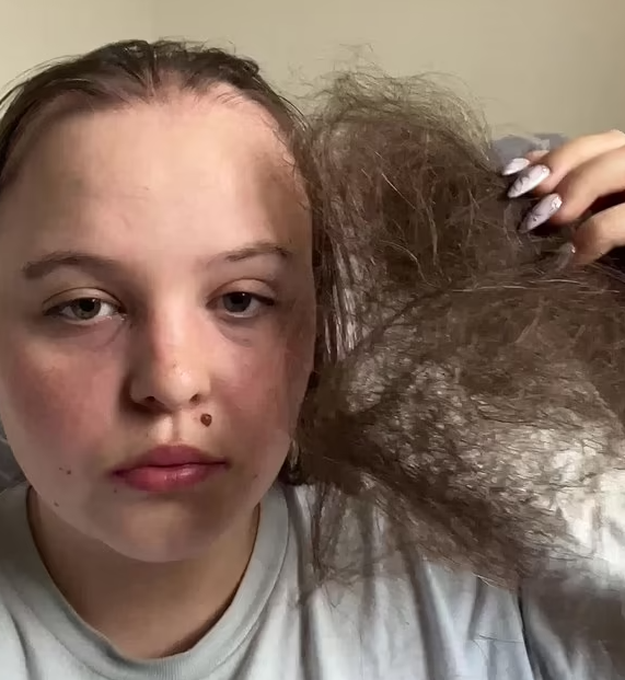 狂掉頭髮時期。(互聯網)