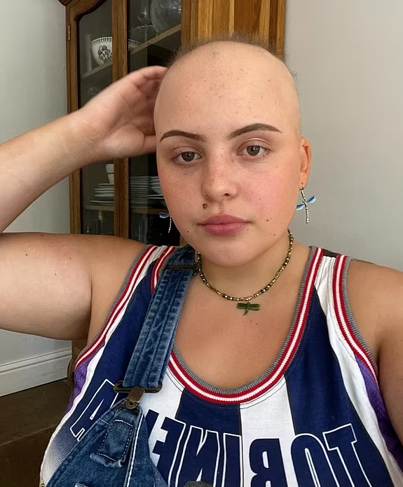 剃光頭後有新頭髮長出。(互聯網)